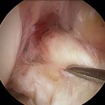 ACL tear arthroscopic view