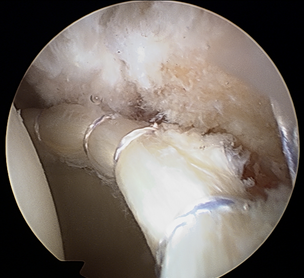 Hip Arthroscopy - Артроскопия тазобедренного сустава - ד