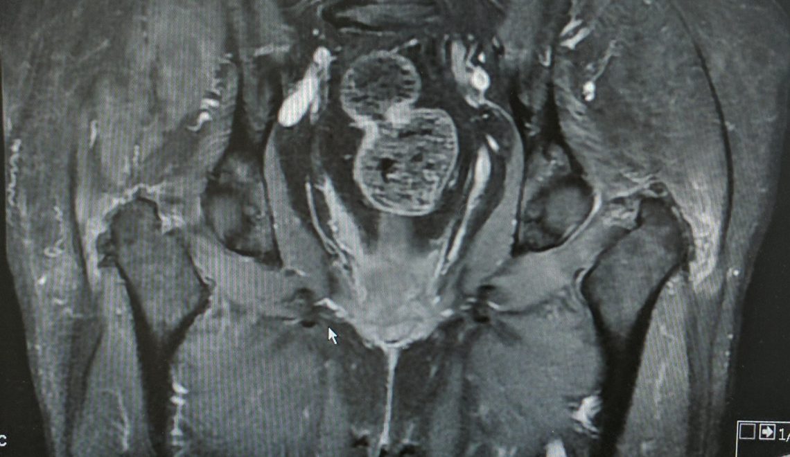 קרע גלוטאוס מדיוס מאובחן בבדיקת MRI