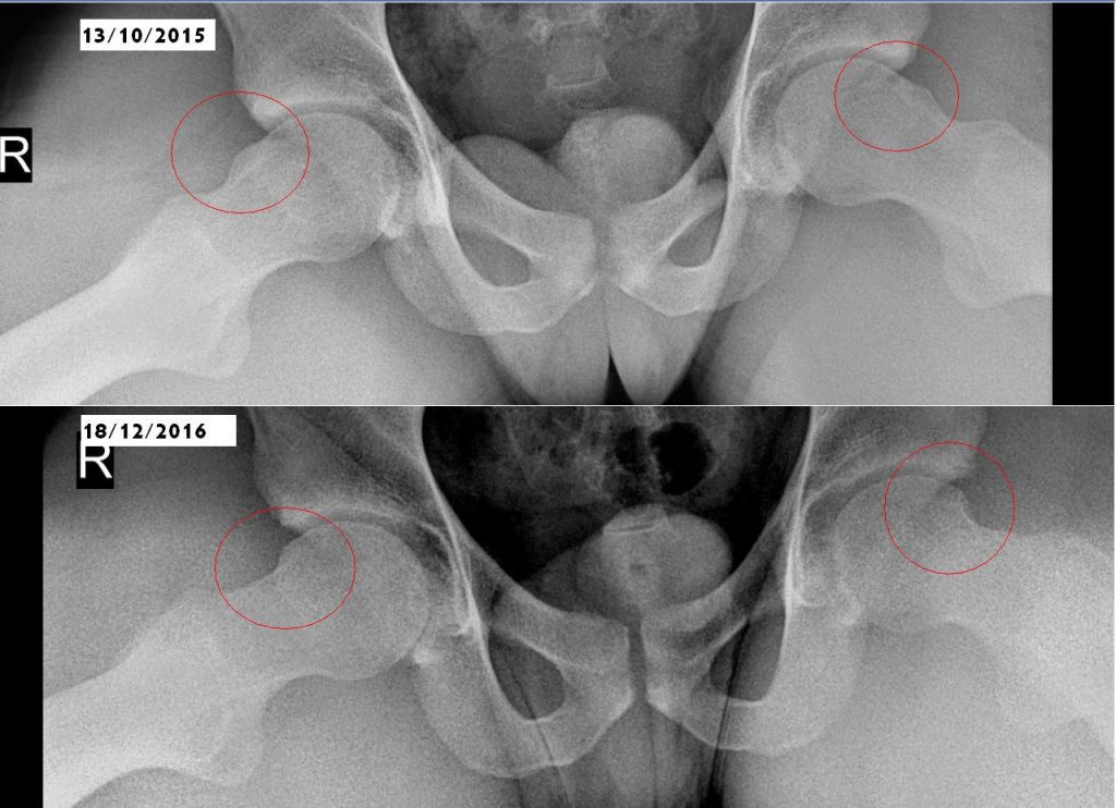 צילום רנטגן שמדגים מבנה קאם דו צדדי שתוקן בניתוח ארתרוסקפיה. הבליטה מופיעה באזור המעבר בין הראש לצוואר ובצילום מוקפת בעיגול אדום.