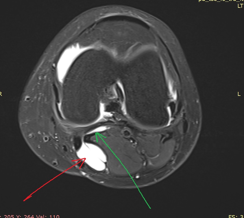 באותה בדיקת MRI בחתכים קורונאלים, ניתן להבחין בציסטה מאחור (מסומנת בחץ אדום)  ובגבעול שמחבר בין הנזלים בברך אל הציסטה (מסומן בחץ ירוק)