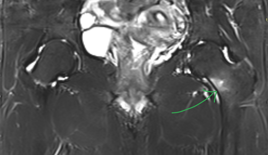MRI של שבר מאמץ בצוואר הירך