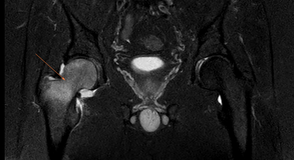 בדיקת תהודה מגנטית (MRI) של אוסטאופורוזיס חולפת של הירך 