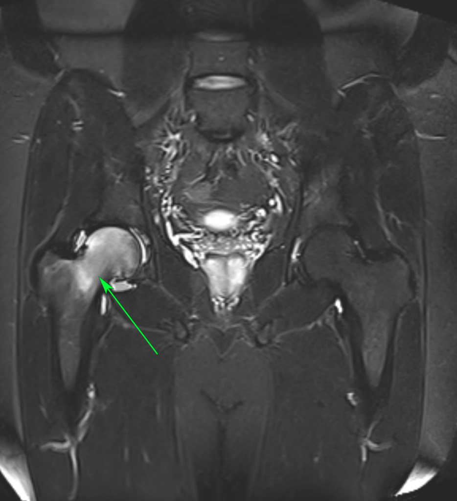אוסטאופורוזיס חולפת של ירך ימין - בבדיקת MRI אפשר לראות בצקת בראש וצוואר הירך