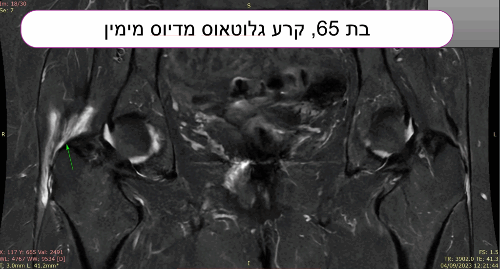 בדיקת MRI תהודה מגנטית שמדגימה קרע של גיד הגלוטאוס מדיוס בירך ימין.