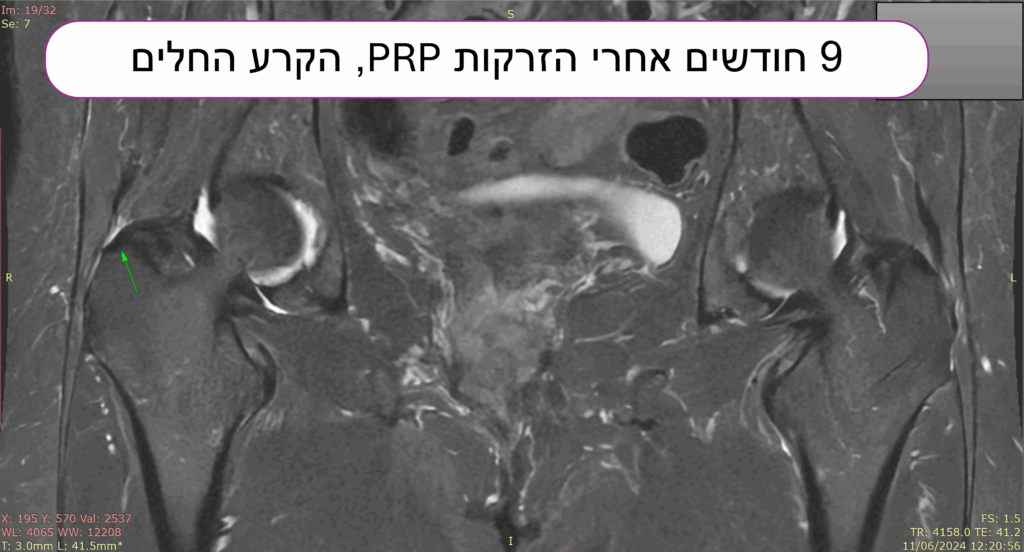 בדיקת MRI תהודה מגנטית שמדגימה החלמה של קרע של גיד הגלוטאוס מדיוס בירך ימין לאחר הזרקות PRP